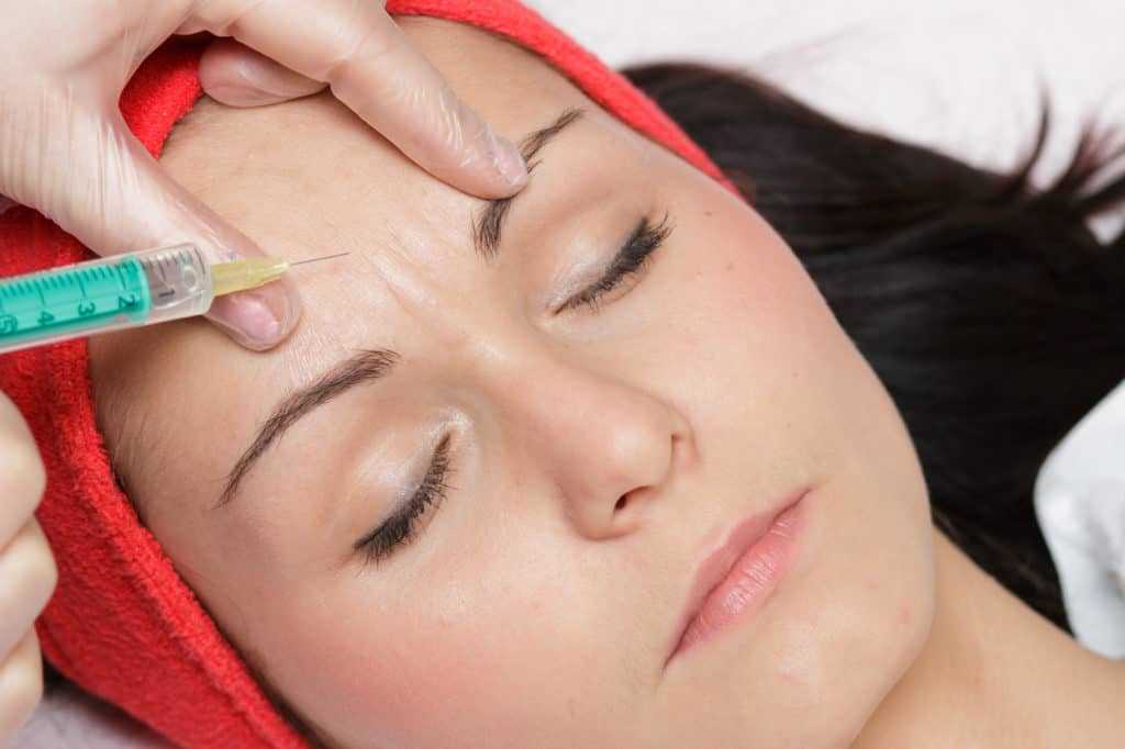 Mezoterapia igłowa - wypełnianie zmarszczek kwasem hialuronowym - rosamed-clinic