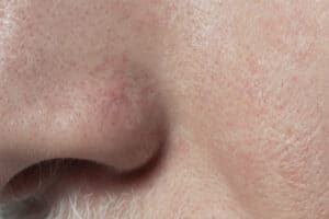 Najlepsze zabiegi na rozszerzone pory | RosaMed Clinic Warszawa