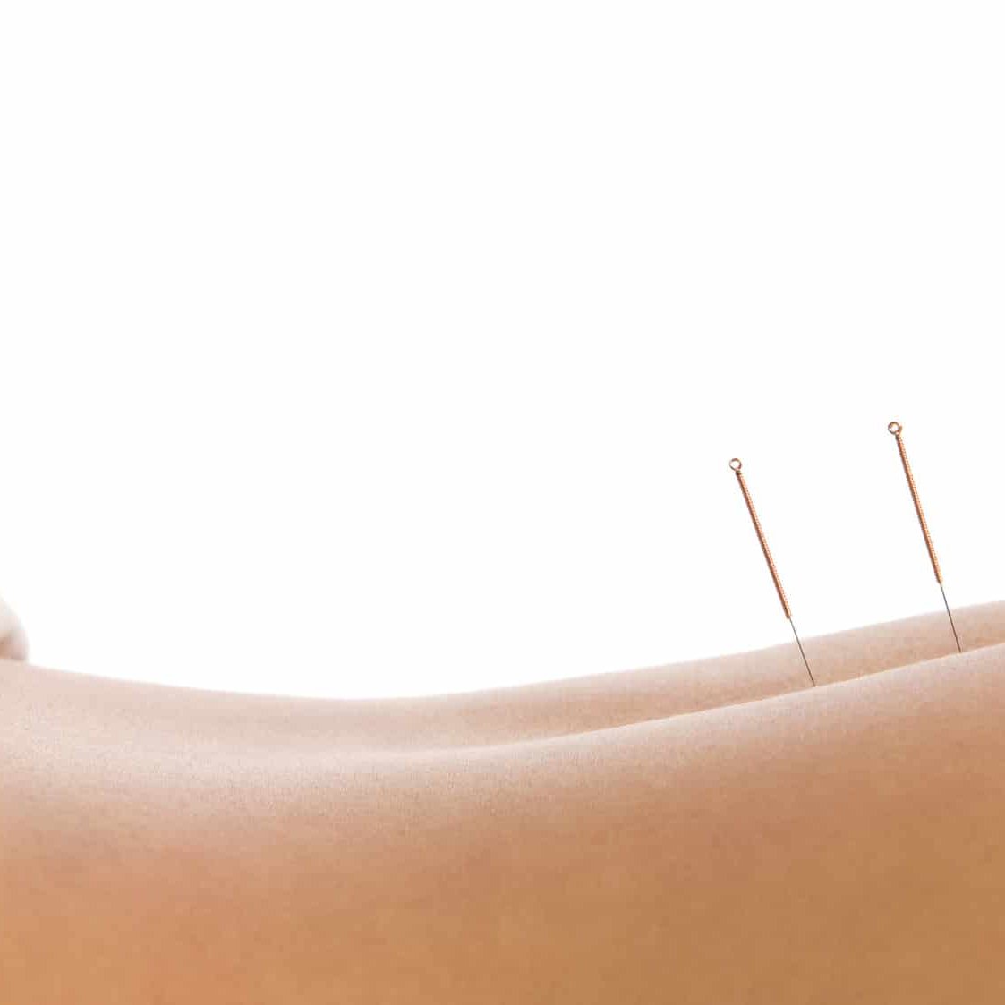 Woman getting an acupuncture treatment in a spa