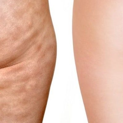 maseczki-na-cellulit