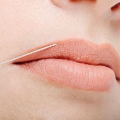 powiekszanie_ust_jak_wyglada_zabieg_122434